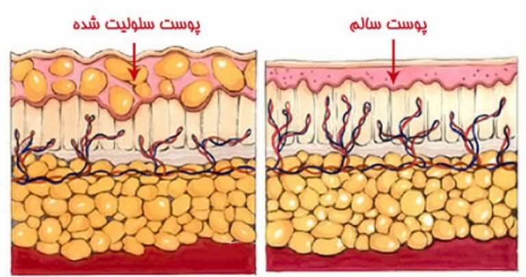 تفاوت پوست سلولیت شده و پوست سالم